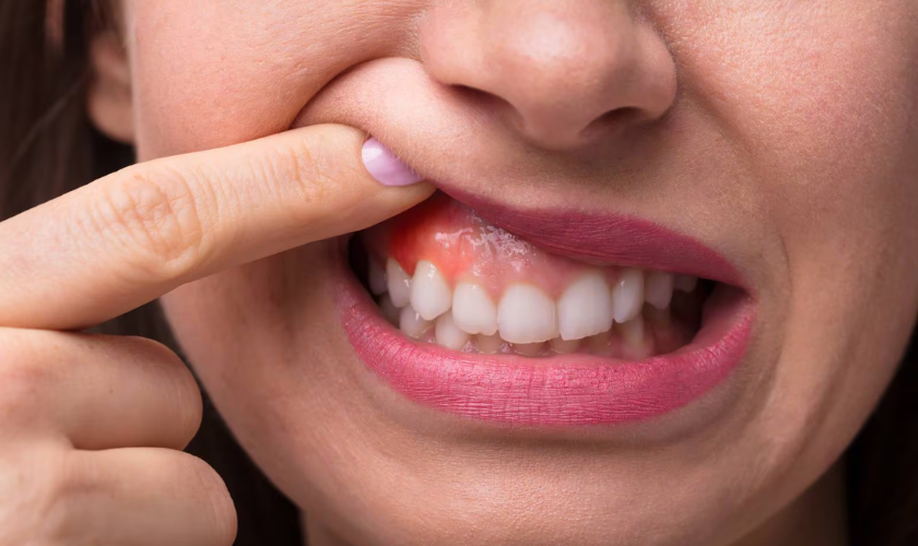 Unveiling the Best Antibiotics for Gum Infections A Comprehensive Guide by American Dentist