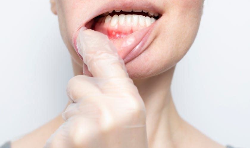 The five most common types of canker sores and how to prevent them ...
