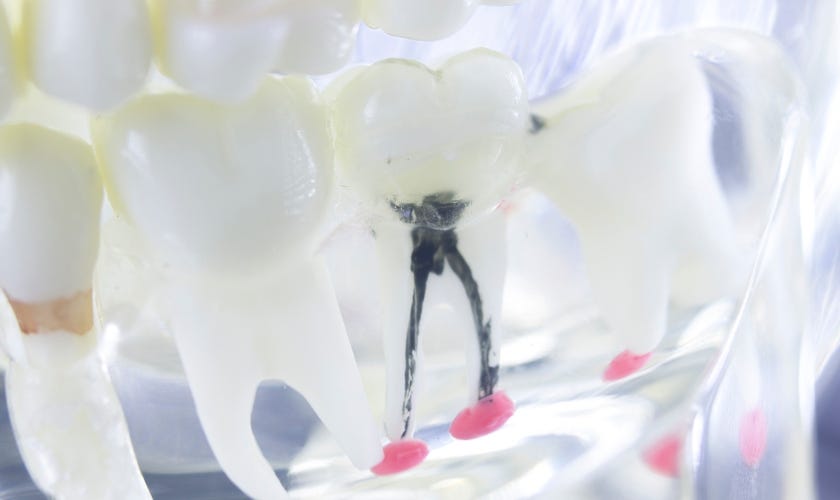 Can Dentists Do Root Canal Procedures? by FLOSS Dental Sugar Land