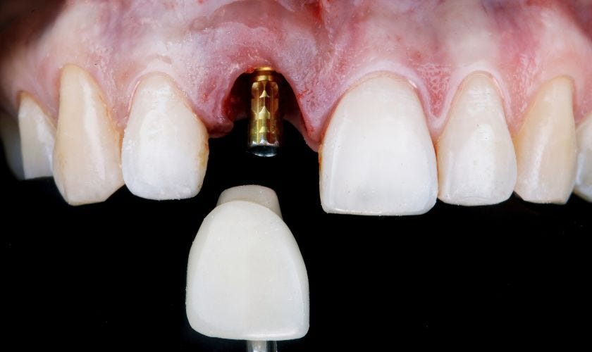 Understanding the Dental Implant Procedure in Colorado Springs, CO by