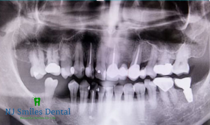 Root Canal Therapy Treatment Process And Benefits! by NJ Smiles