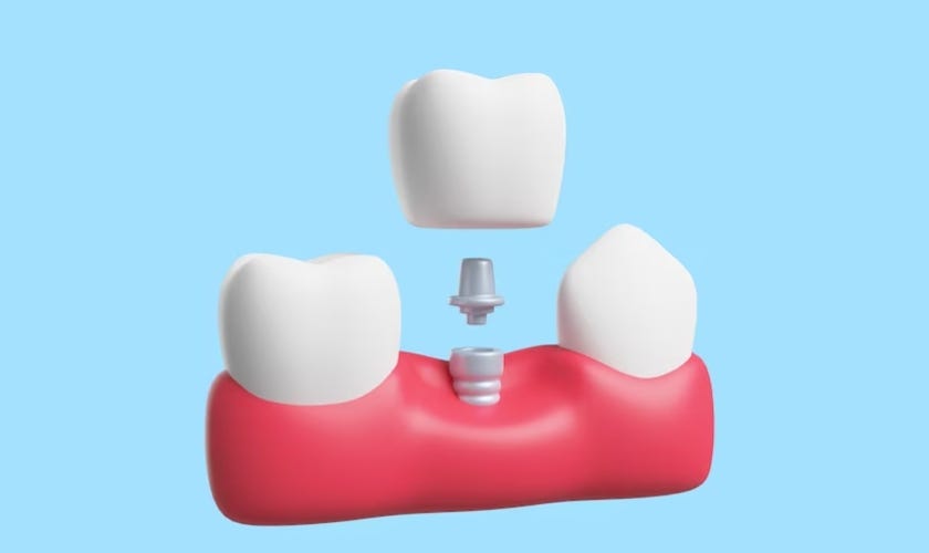 Unveiling the Secrets of Dental Crowns by SAKS Dental Studio Allen