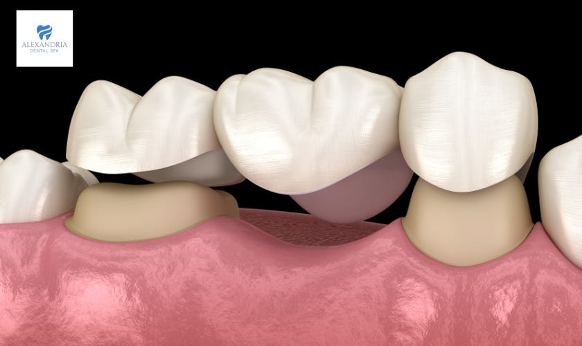 How Long Does a Dental Core Build Up Really Last? by Alexandria Dental Spa Medium