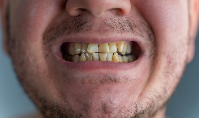 Can Dentist Remove Yellow Stains. Yellow stains on teeth can be a