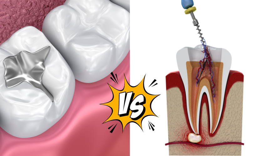 Toothache Treatment Guide Filling vs. Root Canal — Which Is Faster