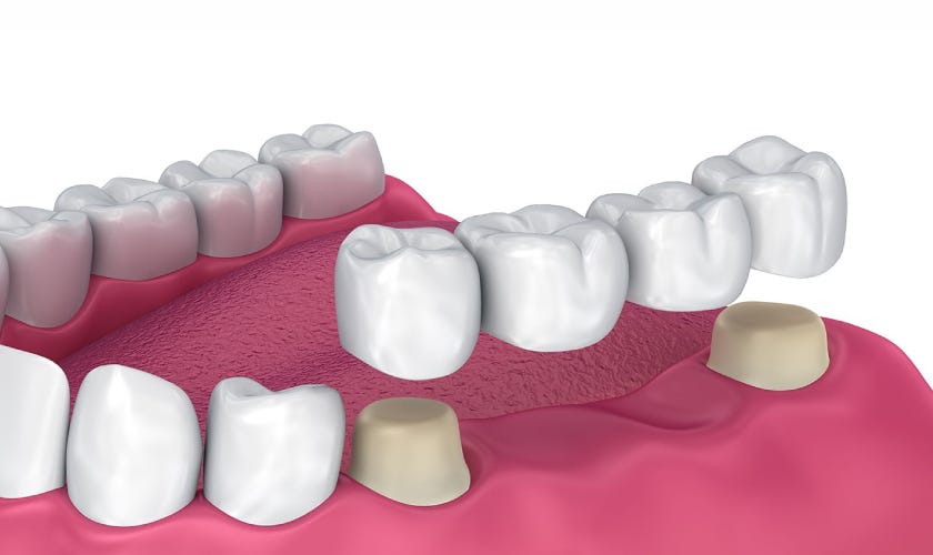 What are dental bridges?. If you have got one or extra missing… by
