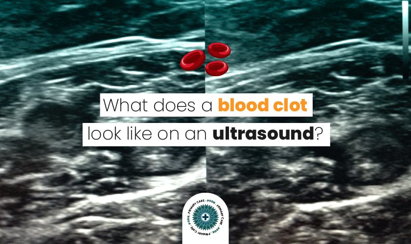 What Does a Blood Clot Look Like on An Ultrasound? by Hadiqarafique
