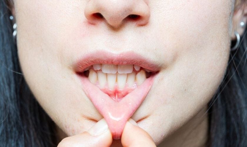 Can a Cosmetic Dentist Fix Receding Gums? by Affinity Dental Queen