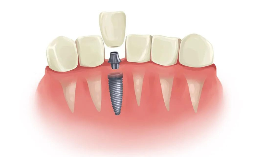 Are Dental Implants Suitable for Everyone? by Northeast Family Dental Care Elgin Jan, 2024