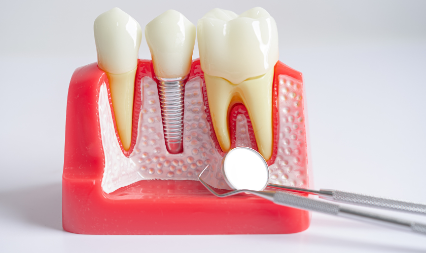 Restoring Your Smile: Dental Implants Repair Explained | by Miel Dental ...