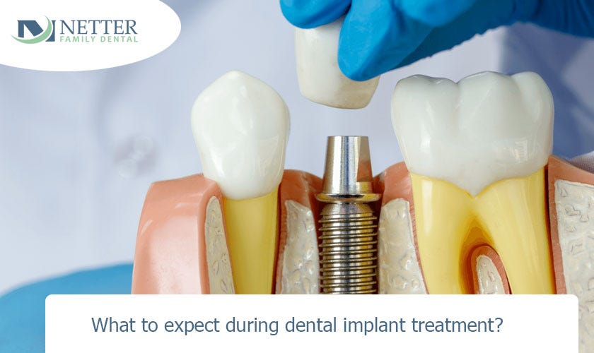 What to expect during dental implant treatment? | by Netter Family ...