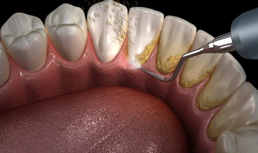 can-a-dentist-remove-hardened-plaque-by-floss-dental-of-pearland