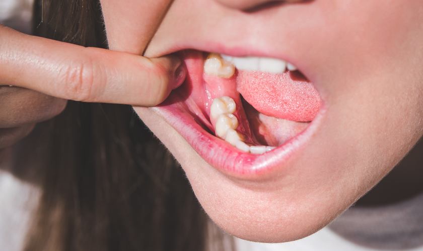 Tooth Extractions What You Need to Know Before, During, and After the
