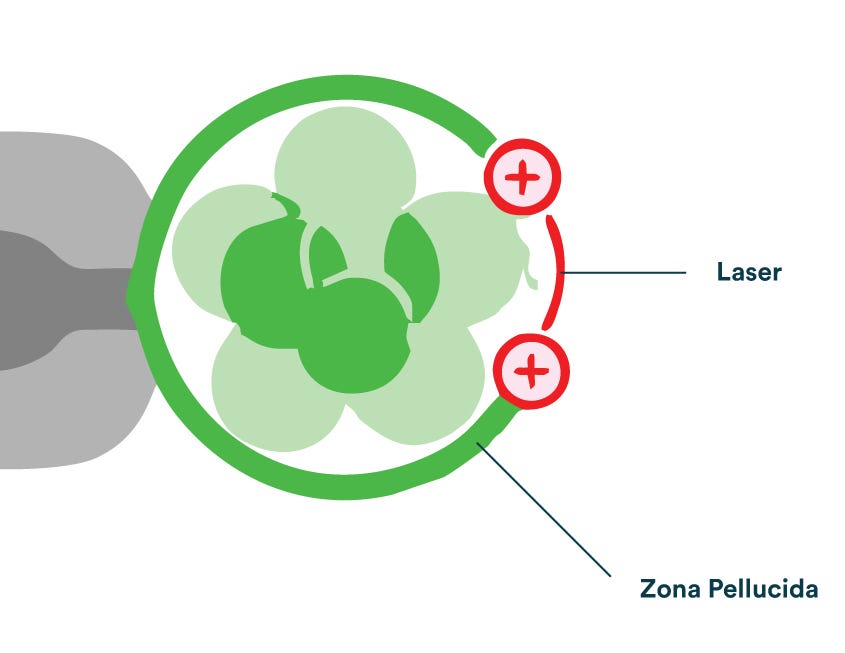 Laser Assisted Hatching in IVF Treatments , Laser Assisted Hatching