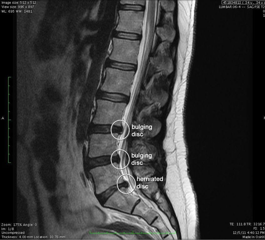 herniated disc x ray