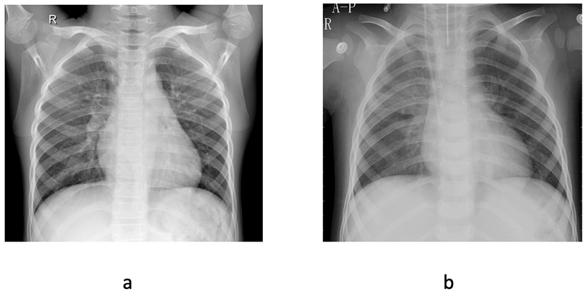 Chest X-ray (圖片來源:researchgate.net)