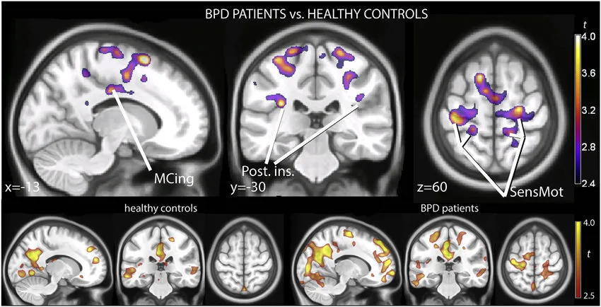 New Research Explores The Nuances Of Borderline Personality Disorder