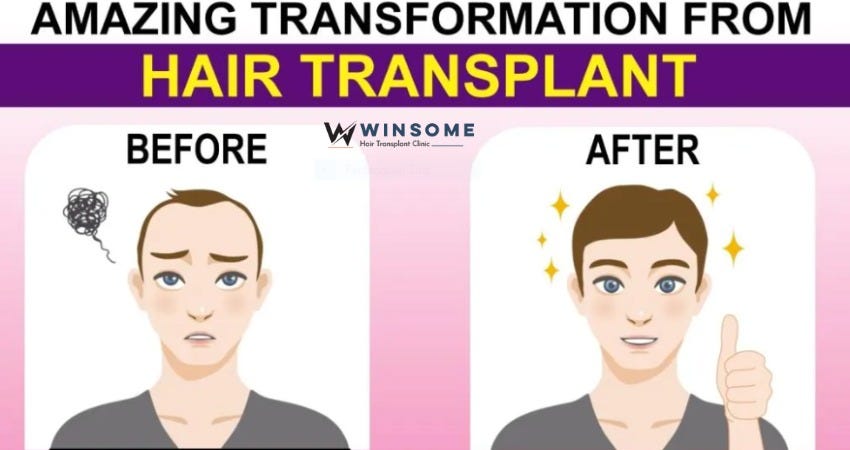 A Guide To Understanding Hair Restoration: Procedures, Costs, And 