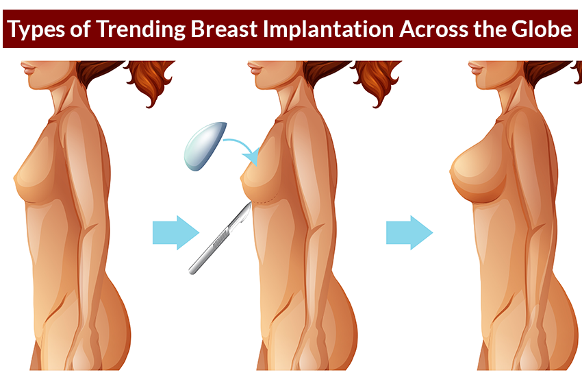 Types of Trending Breast Implantation Across the Globe