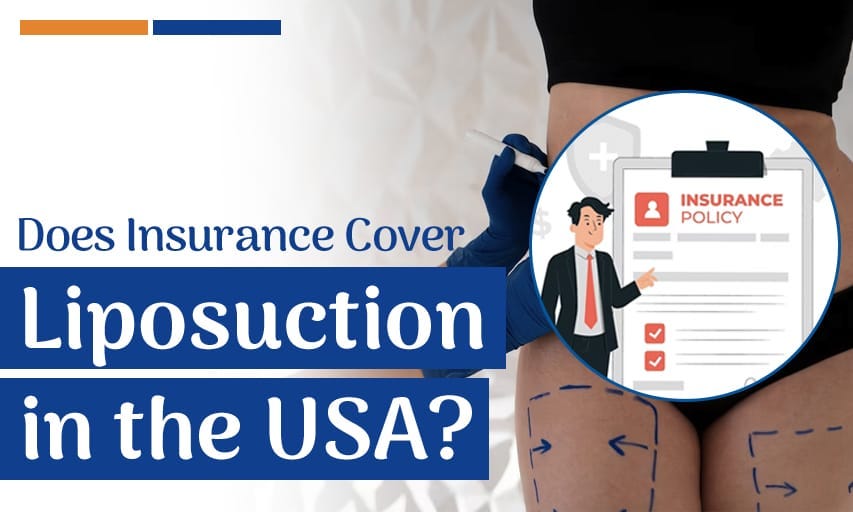 Does Insurance Pay for Liposuction? rb_thumb