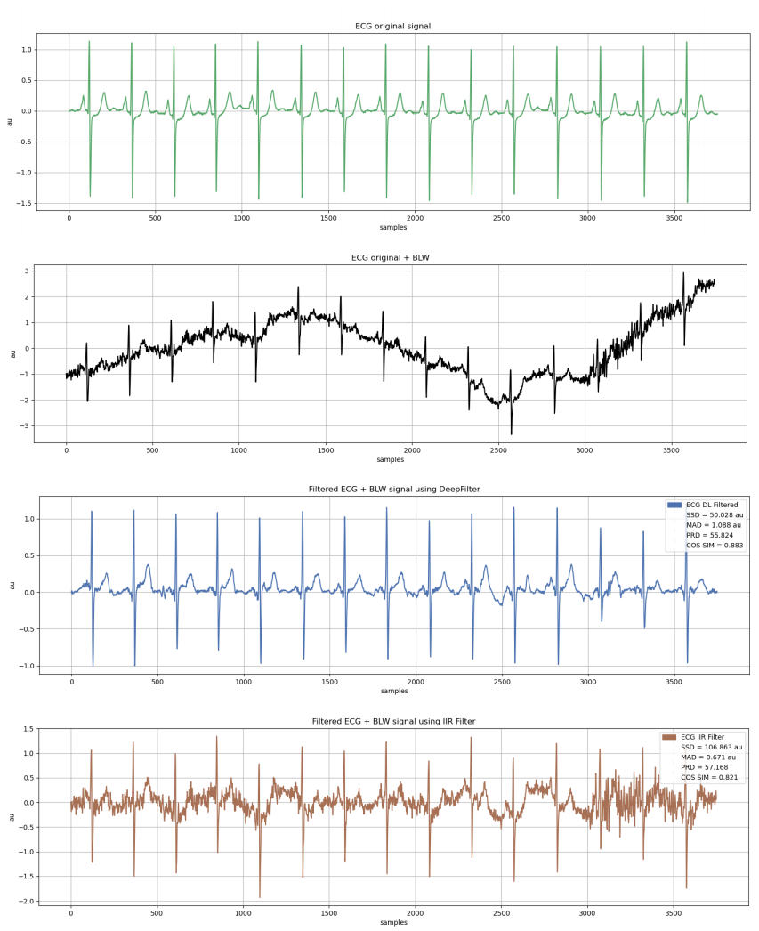 DeepFilter An ECG baseline wander removal filter using deep learning