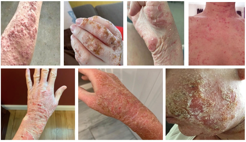 Situasi lengkap TSW (Topical Steroid Withdrawal) di Indonesia dan Kemana Harus Berobat