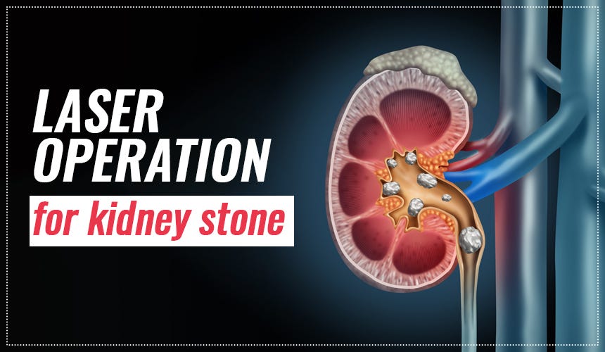 Laser Operation for Kidney Stones — World of Urology by