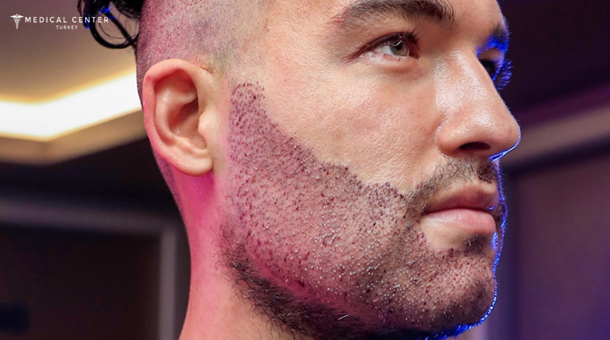 Beard Transplants Are Booming in Turkey