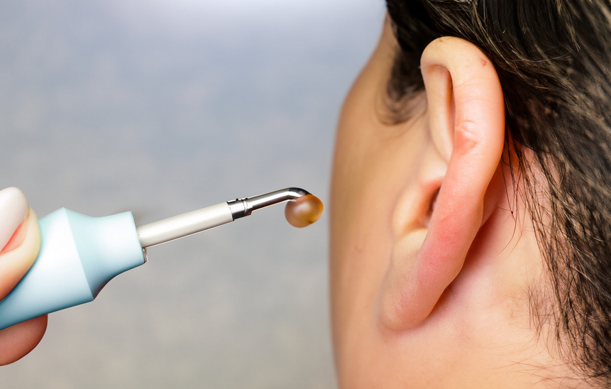 What is Microsuction Ear Wax Removal and How Does it Work? by Paul