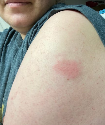 Covid Arm' Rash After the Moderna Shot Is Common but Not ...