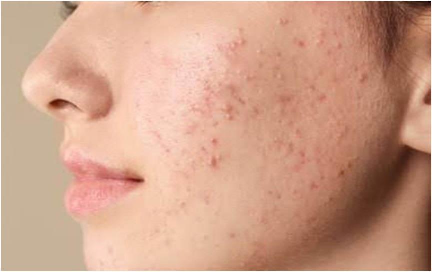 How to get Rid of Pimple in one day? by Misbah Chaudhary Medium