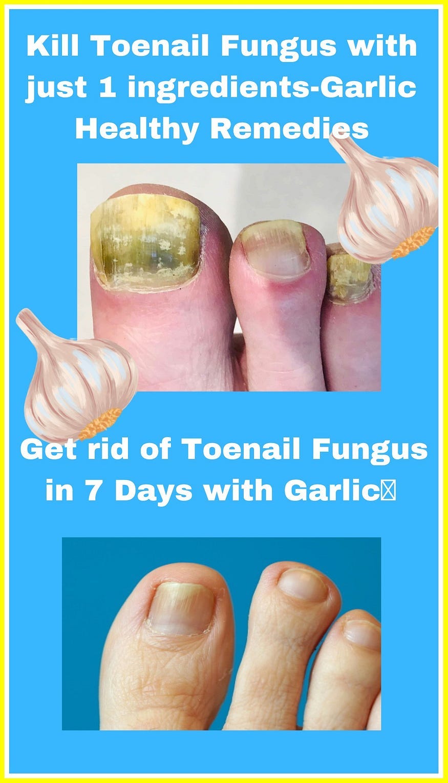 “Nature’s Solution Garlic Drops for Treating Nail Fungus” by