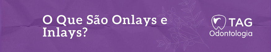 O Que São Onlays e Inlays