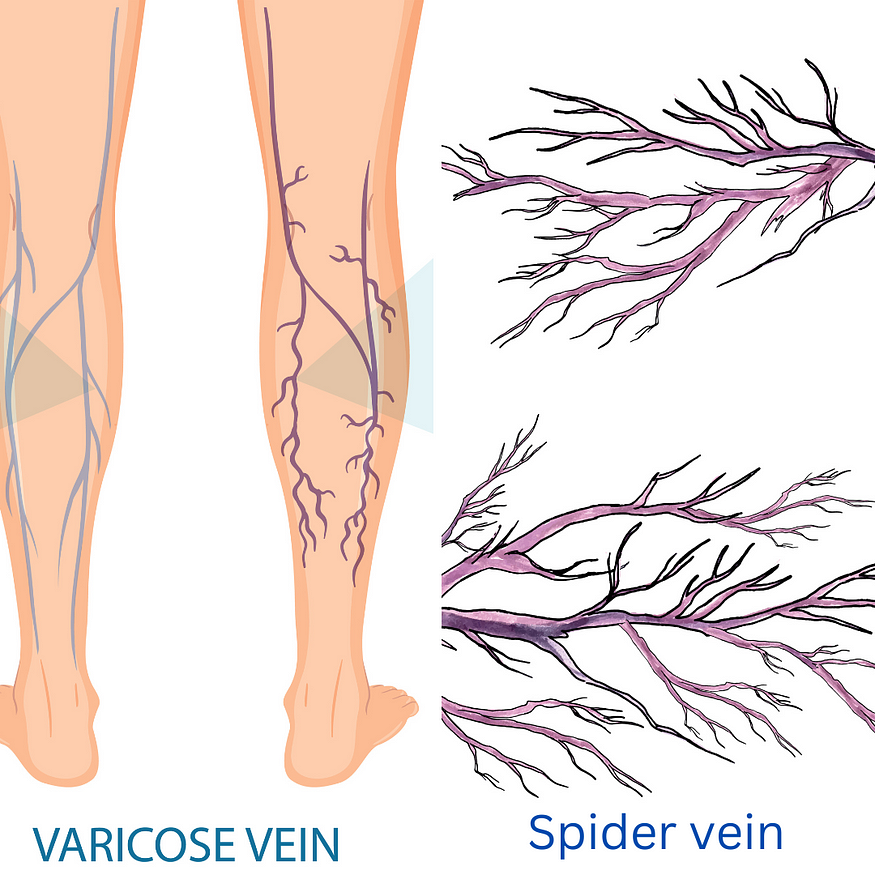 <a href=”https://www.freepik.com/free-vector/vector-branches-collection_1345947.htm">Image by Sketchepedia on Freepik</a> https://www.freepik.com/free-vector/human-legs-with-varicose-vein_28768312.htm
