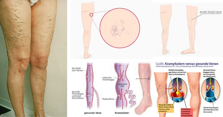 krampfadern kniekehle: Neue Methode zur Beseitigung von Krampfadern in der Kniekehle De behandeling van Krampfadern laat de Knie een van de meest waarschijnlijke problemen zien. Zorg voor een gezonde levensstijl, een regelmatige controle, gewichtsbeheersing en lagere niveaus van belasting, het uitvoeren van de doorlopende blussingen en het afwerken van de lindern.