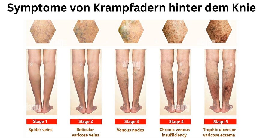 Het herkennen van het symptoom van Krampfadern geeft aan dat de knel een rechtmatige interventie is door afzonderlijke beddeutung. Beïnvloede können in getroffen Bereich Schmerzen, Schmerzen, Pochen en een schweres Gefühl verspüren.