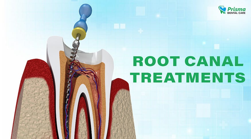Root Canal Treatment