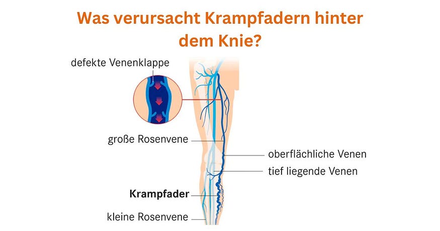 krampfadern kniekehle: Neue Methode zur Beseitigung von Krampfadern in der Kniekehle De Ursachen von Krampfadern laten de Knie zien dat de Krampfadern herkömmlicher is. Deze faktoren hebben een systematische verrekening, langere stehen of sitzen, hormoonverzendingen (z. B. Schwangerschaft of Wechseljahre), fettleibigkeit en veranderde bedingte Schwächung der Venenwände.