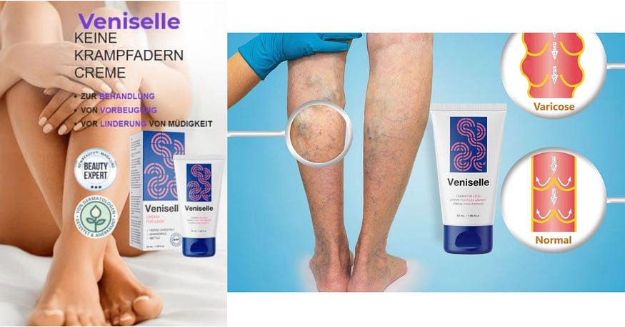De voorbereiding en behandeling van Krampfadern geven een hint aan een nieuwe strategie, de aanpassing van de levensstills, medische eingriffe en fachkundige combinatie van beratung