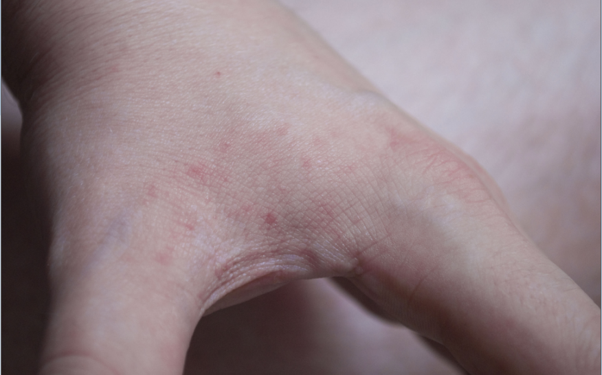 How Do BedBug Bites Look Like on Human Skin by NYC BED BUGS Medium