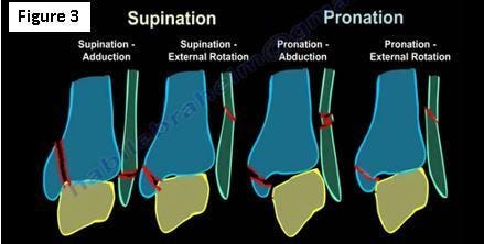 Ankle Fractures. There are many of important topics…, by Nabil Ebraheim, Thrive Global