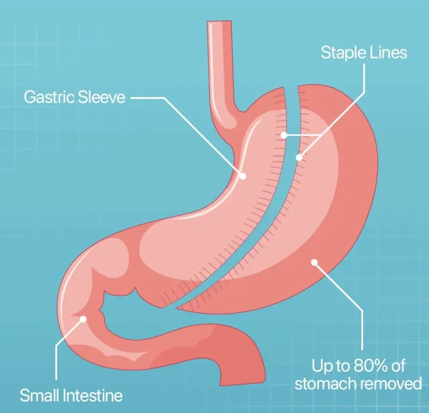 What Does Gastric Bypass Vitamin Deficiency Mean? by Classy Sassy
