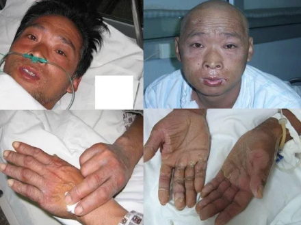 Hisashi Ouchi: The Man Who Begged Doctors to End His Suffering. | by A  well-wisher | Medium