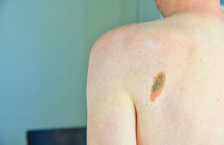 Navigating Basal Cell Carcinoma: Radiation Options - Florida Skin 