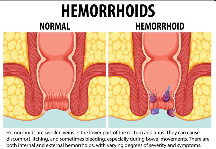 Piles Treatment in Chandigarh