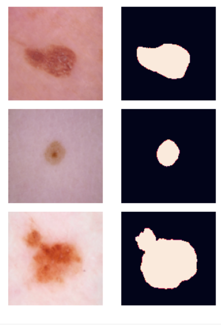 How I built Supervised Skin Lesion Segmentation on HAM10000 Dataset