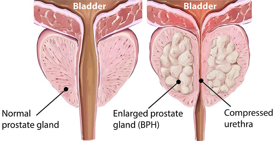 What Is BPH?