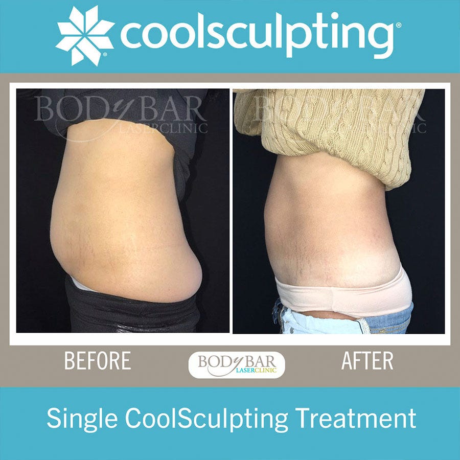 What Is Coolsculpting And How It Really Works? by Body Bar Laser