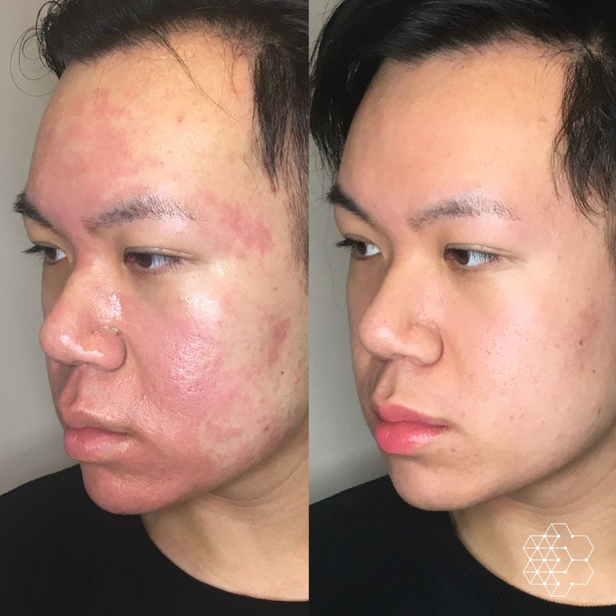 Laser Treatment for Acne Scars Achieve Radiant Skin by Amartya