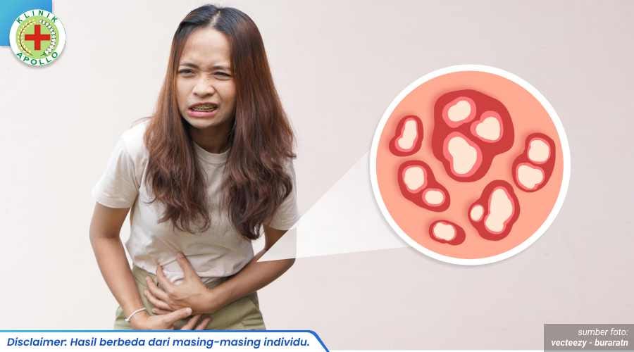 Cara Mengatasi Bintik Bernanah di Kemaluan Wanita
